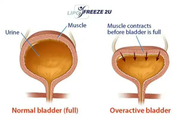 diagram of overactive bladder treatment Slough