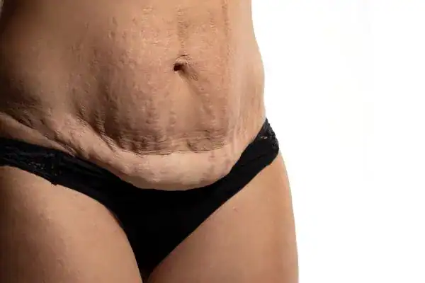loose skin after weight loss injections Slough