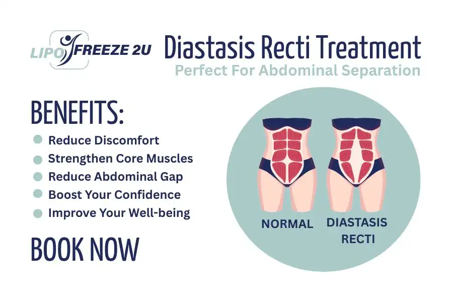 Benefits of body toning treatment Slough for Diastasis recti