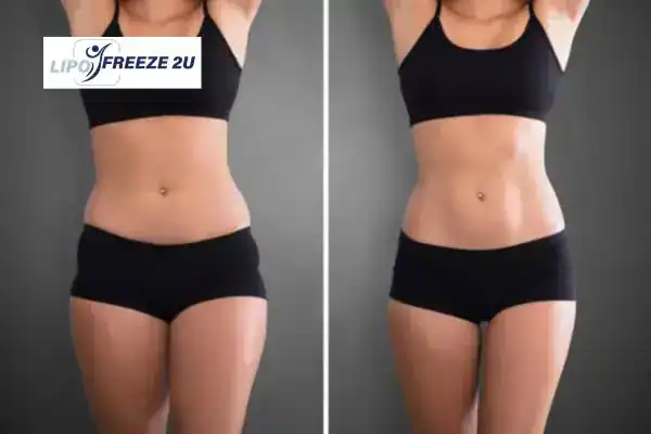 How Can LIPO FREEZE 2U Support Your Post-Pregnancy Body Recovery Slough?