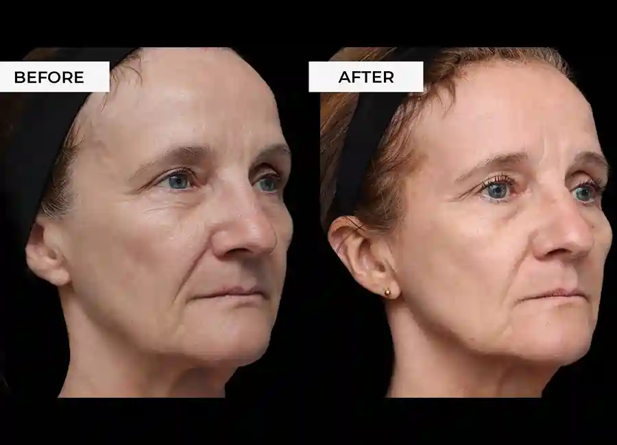 How Many RF Microneedling Sessions Will You Need to See a Difference Slough?