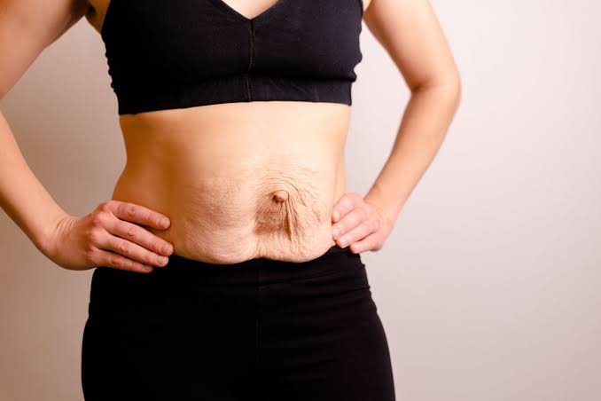 Is Surgery Really the Only Way to Repair Diastasis Recti Slough?
