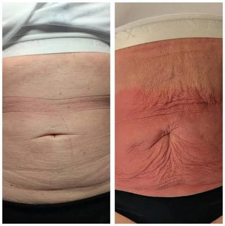 How Does RF Microneedling Improve Crepey, Thin and Uneven Skin Texture Slough?