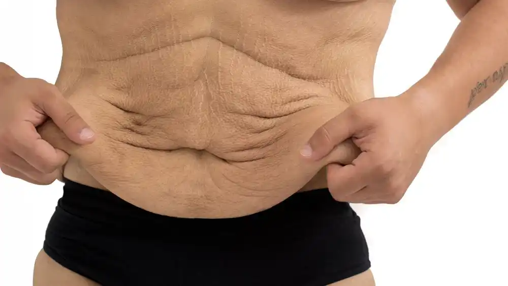 Why Does Weight Loss Medication Leave Some People With Loose or Sagging Skin Slough?